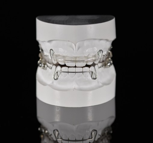 Example of an orthodontic expansion appliance used in early orthodontic treatment