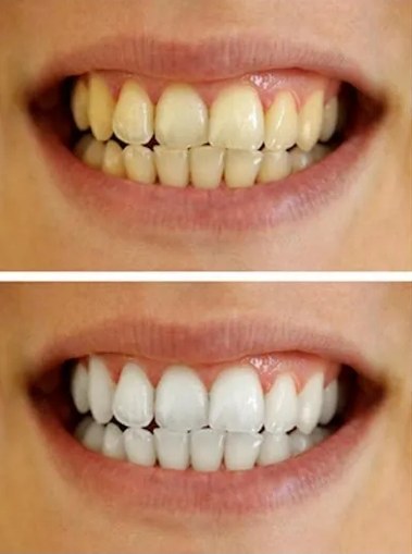 Illustration of teeth before and after whitening