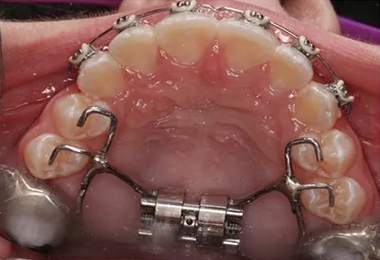 Traditional Metal Braces