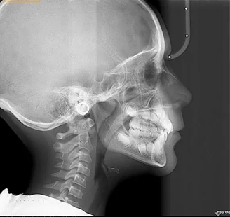 Orthodontic Treatment Results